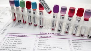El doktoru idrar ve kan tüpü testi yapıyor doping ya da uyuşturucu analizi için. Doktorun eli idrar tahlili ve uyuşturucu testi ya da alkol için kan örnekleri ile tıbbi rapor üzerinde
