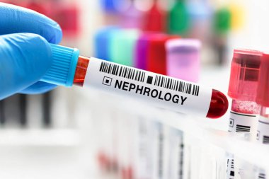 Doktor böbrek fonksiyon testi için kan örneği tutuyor. Laboratuvarda Neştoloji testi için alınan kanla çalışan teknisyen laboratuarı.