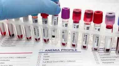 Anemi analizi için hastadan alınan kan örneği. El doktoru Anemia testi için kan tüpü tutuyor.
