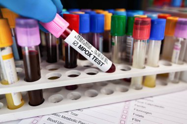 Çiçek hastalığı ve Maymun Çiçeği 'nin (MPXV) analizi için kan toplama tüpleri olan teknisyen. MPOX maymun hastalığı testi için kan tüpü tutan doktor.