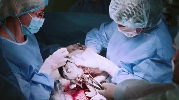 婴儿在剖腹产时出生 一群戴面具的医生把头靠在病人身上 医生进行剖腹产手术 医生和护士正在拉一个新生儿 妇产医院 — 图库视频影像