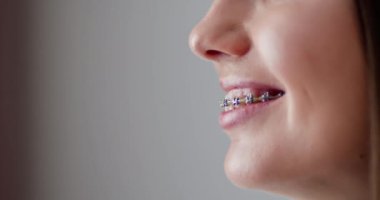 Dental Braces And Healthy Teeth. Close up of a woman with dental braces smiling. Concept of orthodontic treatment and oral hygiene. Beautiful smile showcasing metal braces for teeth alignment