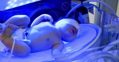 Yeni doğan bebek tıbbi kuvözde. Erken doğan bebek terapide. Prematüre yeni doğan bebek, yeni doğan yoğun bakım ünitesinde sezaryen sonrası hastane inkübatöründe mavi ışık terapisi görüyor.