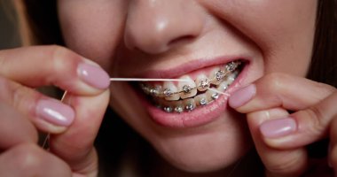 Close-up of woman cleaning dental braces with floss. Concept of oral hygiene and orthodontic care. Detailed view of orthodontic treatment and health maintenance routine. Braces Dental Care clipart