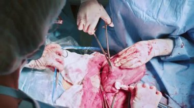 Ameliyat sırasında karnında açık yarayla kanlı bir yakın çekim. Ameliyathanede ameliyat yapan bir grup sağlık çalışanı. Hastaneler. Bir tümörü almak için ameliyat yapan bir cerrah ekibi. 18