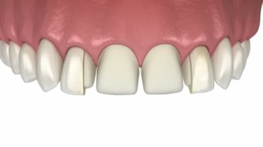 Veneers - hazırlama, modelleme, renk seçimi ve diş kaplamalarının merkezi kesici diş ve yan kesici dişlerin üzerine yerleştirilmesi. Tıbbi olarak doğru diş 3D animasyonu