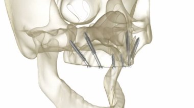 Elmacık kemiği implantları tarafından desteklenen Maxillary protezi. İnsan dişlerinin ve protezlerinin tıbbi açıdan doğru üç boyutlu animasyonu