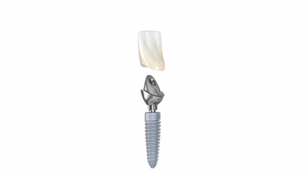 Ceramiczna Korona Niestandardowe Implanty Proces Montażu Implantu Medycznie Dokładna Animacja — Wideo stockowe