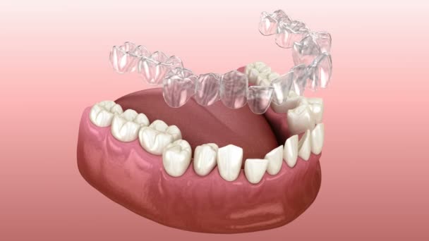 Invisaligne Zahnspangen Oder Unsichtbare Halter Führen Zur Bisskorrektur Medizinisch Korrekte — Stockvideo