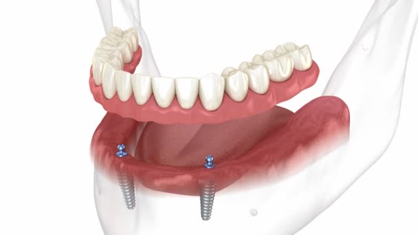 Prótesis Extraíble Mandibular Todo Sistema Soportado Por Implantes Con Implantes — Vídeo de stock