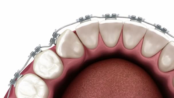 用支撑架作轻微的矫正 医学上准确的牙科3D图像 — 图库视频影像