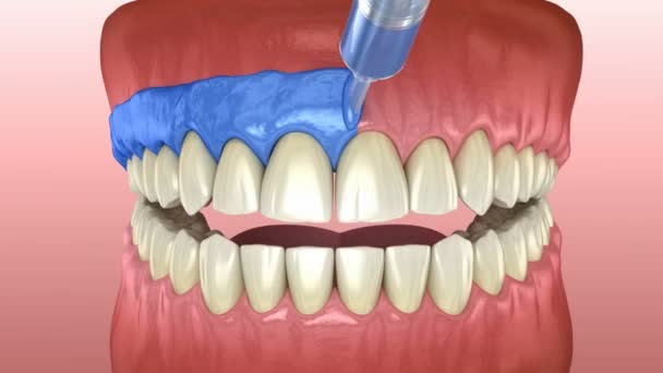 Proffesioinal Zęby Wybielanie Światło Aktywacja Wybielanie Zębów Koncepcja Animacji — Wideo stockowe