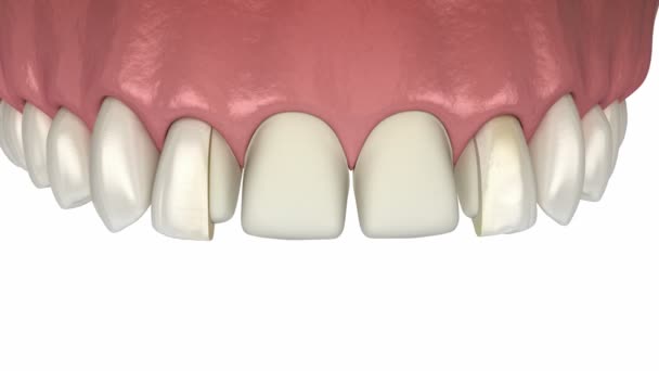 假牙的准备 颜色选择和在中央门牙和侧牙上放置假牙 医学上准确的牙齿3D动画 — 图库视频影像