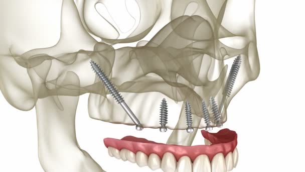 上颌骨和下颌骨假体 由人工晶状体支持 医学上准确的人类牙齿和假牙3D动画 — 图库视频影像