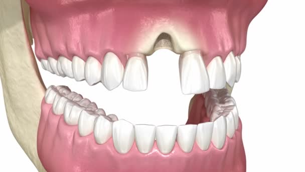 Kemik Nakli Büyütme Soket Koruması Diş Nakli Tıbbi Olarak Doğru — Stok video