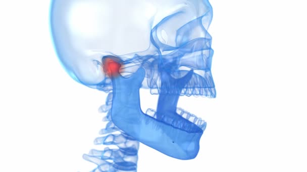 Problema Articulação Temporomandibular Animação Medicamente Precisa — Vídeo de Stock