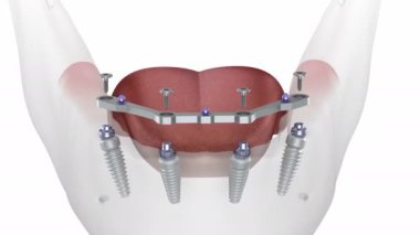 Çikletli çene protezi. Hepsi de implantlar tarafından desteklenen 4 sistemde. Tıbbi olarak doğru 3B canlandırma