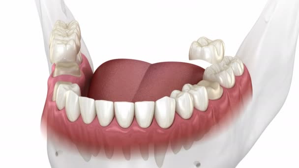 Instalation Dental Bridge Single Crown Medically Accurate Animation — Stock Video