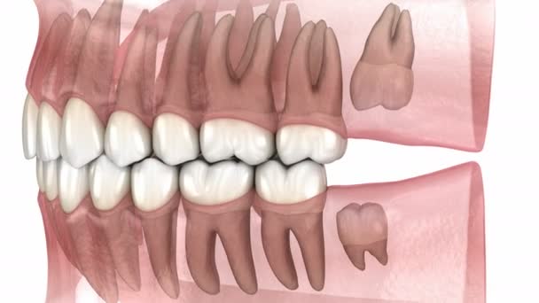 Zapalenie Zębów Mądrości Dziąseł Medycznie Dokładna Animacja Zęba — Wideo stockowe