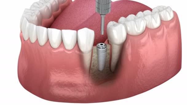 Krycí Šroub Hojící Víčko Přes Implantát Lékařsky Přesná Zubní Animace — Stock video