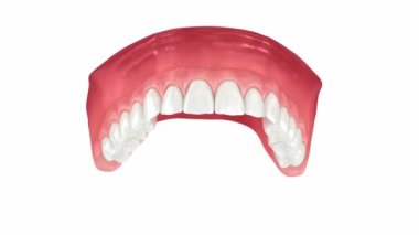 Maxillary protezi 2 diş ve 4 implantla destekleniyor. Tıbbi olarak doğru 3B canlandırma