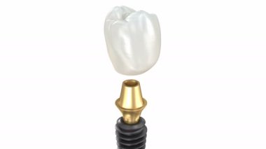Seramik taç, özel implant abutment ve yerleştirme işlemi. Tıbbi olarak doğru 3B canlandırma.