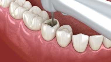 Bileşik dolgusu olan azı dişi restorasyonu. Tıbbi olarak doğru diş 3D animasyonu