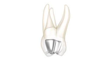 Amalgam and tooth destruction. Medically accurate 3D animation of dental concept