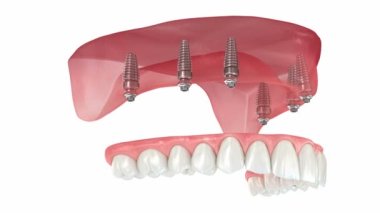 Maxillary prosthesis with gum All on 6 system supported by implants. Dental 3D animation