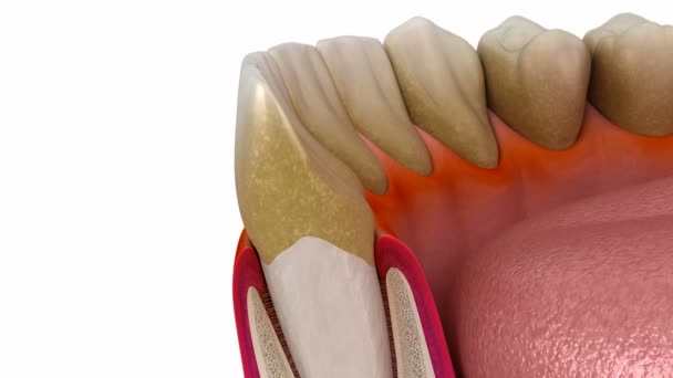 Periodontitis Gum Recession Process Medically Accurate Animation — Vídeo de Stock