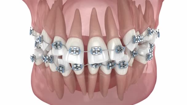 牙齿位置不正常 用金属矫形器矫正错误 医学上准确的牙科3D动画 — 图库视频影像
