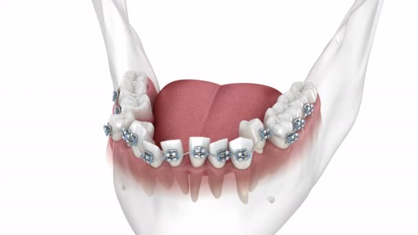 牙齿位置不正常 用金属矫形器矫正错误 医学上准确的牙科3D动画 — 图库视频影像