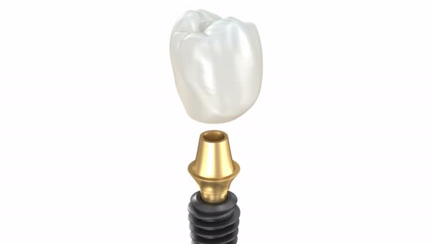 Ceramic Crown Custom Implant Abutment Implantat Instalation Process Medically Accurate — Stock Video
