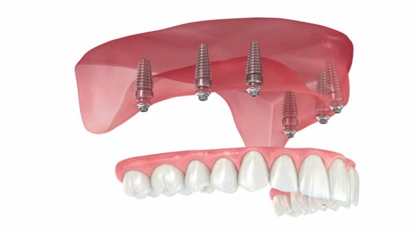 Oberkieferprothese Mit Zahnfleisch Alles Auf System Das Durch Implantate Unterstützt — Stockvideo