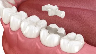 Inlay ceramic crown placement. Medically accurate 3D animation