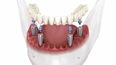 Alt çene protezi hepsi implantlar tarafından desteklenen 4 sistemde. Tıbbi olarak doğru 3B canlandırma