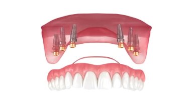 Removable prosthesis with gum All on 6 system supported by implants. Dental 3D animation