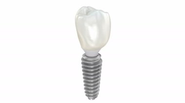 Seramik taç, özel implant abutment ve yerleştirme işlemi. Tıbbi olarak doğru 3B canlandırma