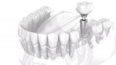 Dental Implant and ceramic crown. 3D animation of human teeth