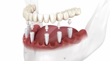 Dental prosthesis based on 6 ceramic implants. Dental 3D animation