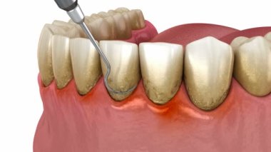Diş skalası (geleneksel periodontal terapi). Tıbbi olarak doğru 3B canlandırma