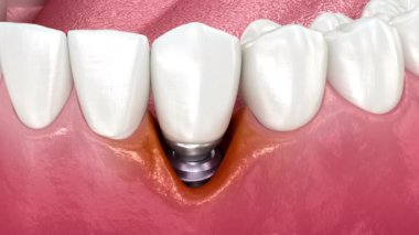 Peri-implantitis ve gingiva durgunluğu. Diş 3B canlandırması