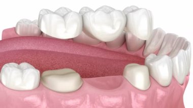 Dental bridge based on 2 teeth. Medically accurate 3D animation