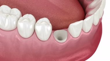 Dental stump pin tab on canaine tooth. Medically accurate dental 3D animation