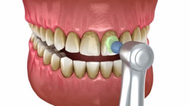Teeth polishing procedure with professional brush and gel. Dental 3D animation