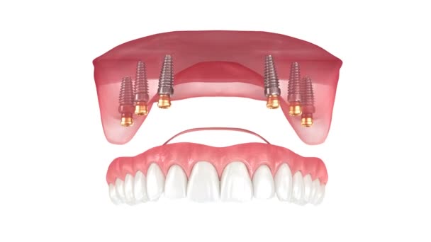 Removable Prosthesis Gum All System Supported Implants Dental Animation — Vídeos de Stock