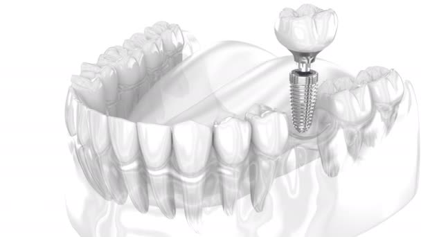 Impianto Dentale Corona Ceramica Animazione Denti Umani — Video Stock