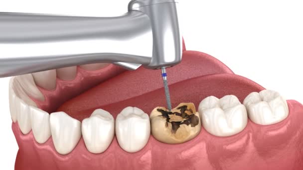 Caries Removing Preparation Dental Impression Crown Placement Animation — Vídeo de Stock