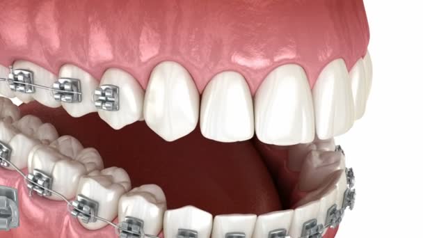 Dental Braces Placement Orthodontic Treatment Dental Animation — Stok Video