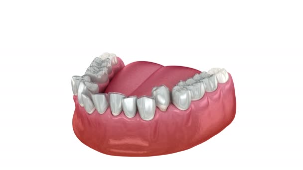 Diş Telleri Görünmez Diş Telleri Isırık Düzeltmesini Sağlar Tıbbi Olarak — Stok video